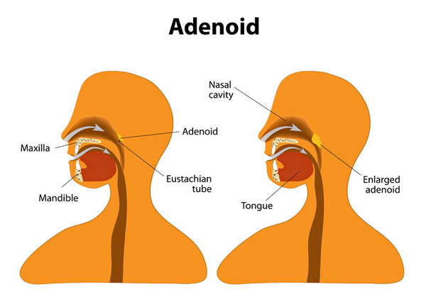 Illustration of enlarged adenoid. Adenoidectomy.