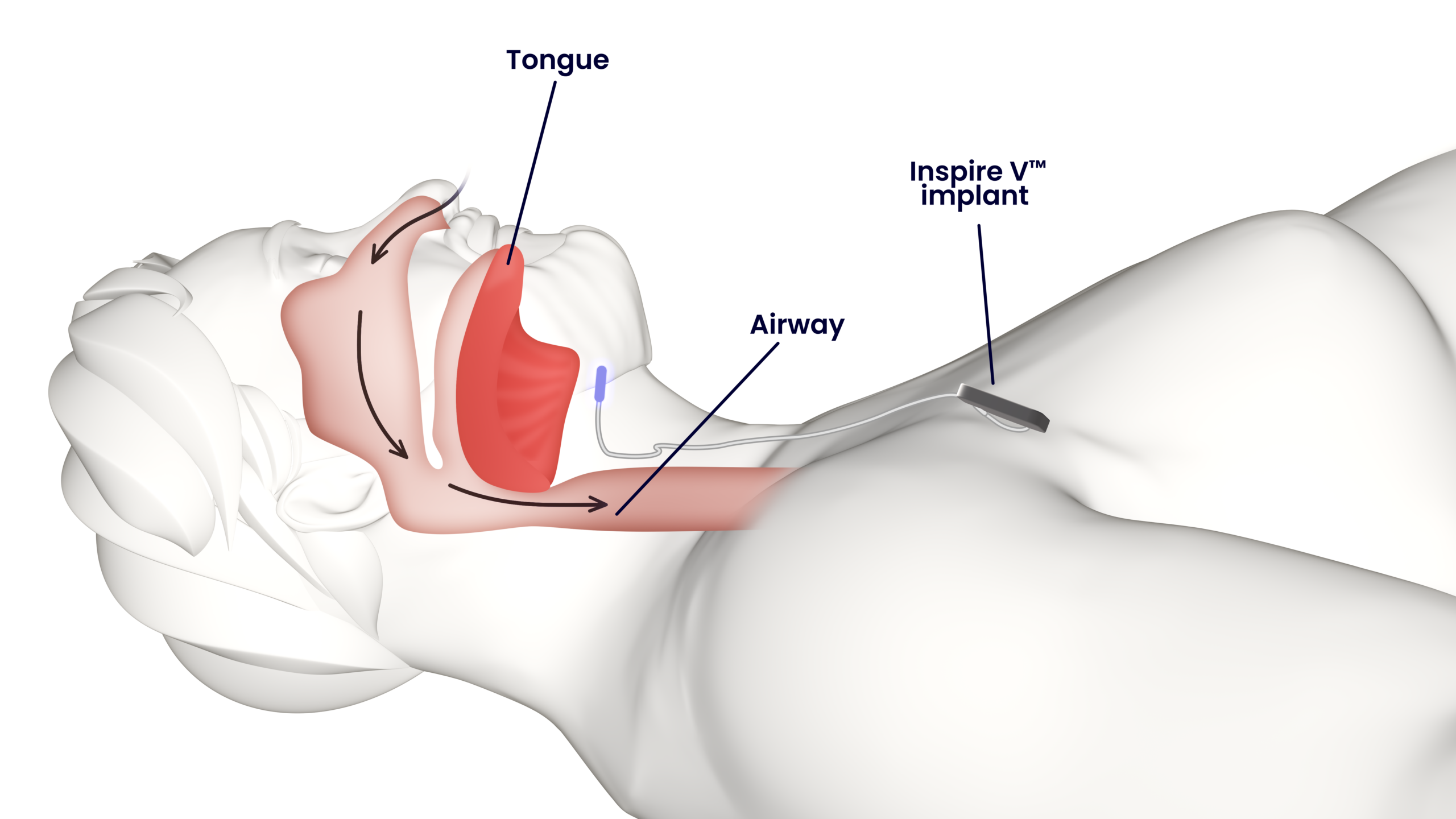 Inspire sleep apnea graphic